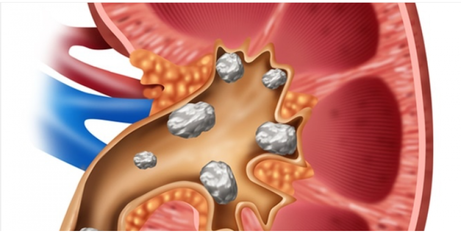 Kidney Stones managed by Functional Medicine